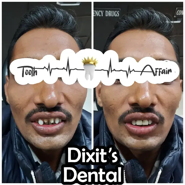 Before and after whitening result